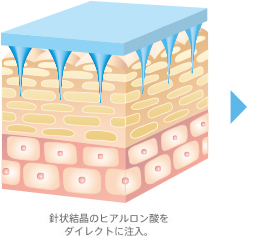 針状結晶のヒアルロン酸をダイレクトに注入。