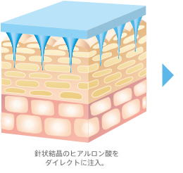 針状結晶のヒアルロン酸をダイレクトに注入。