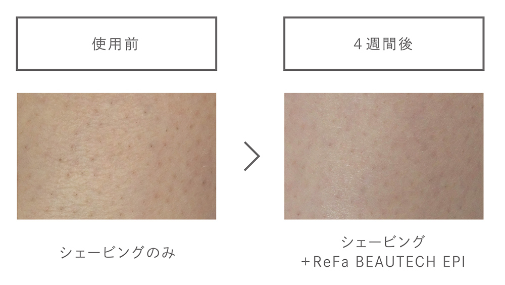 簡単操作で本格的なムダ毛ケアを叶えるIPL光美容器「ReFa BEAUTECH EPI